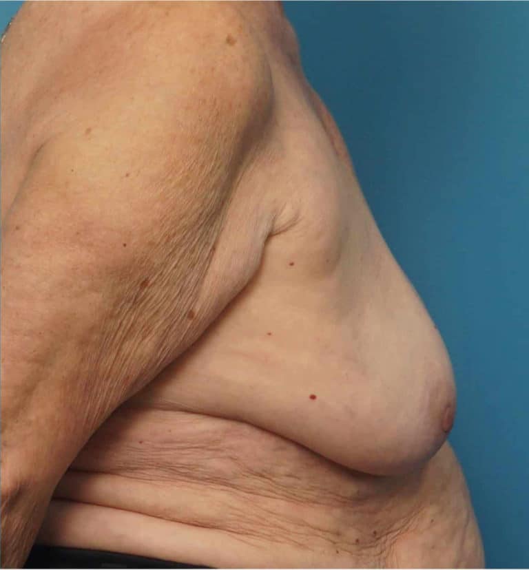 After Image: Breast Implant Removal - right-side