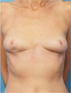 Breast Lift and Implant Removal