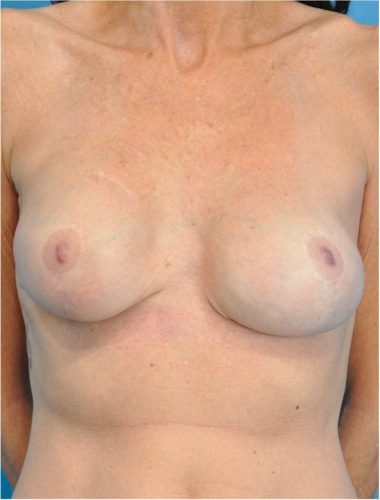 Before Image: Breast Lift and Implant Removal - front
