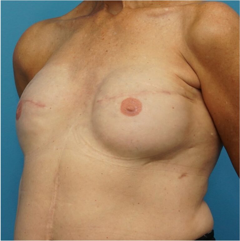 After Image: Breast Reconstruction Revision - left-front-oblique