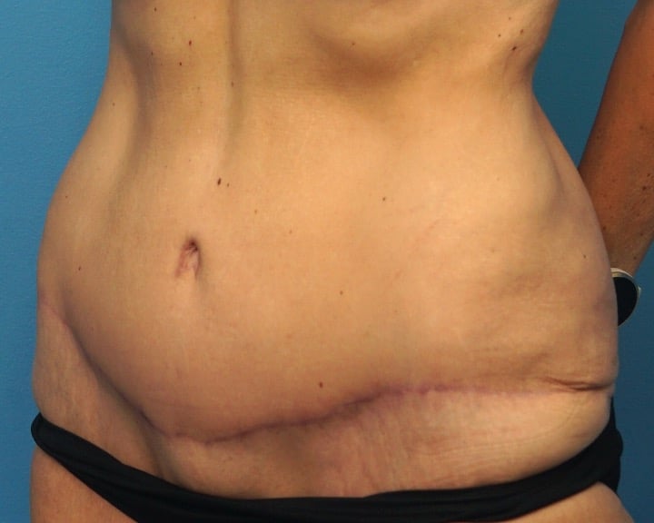 After Image: Tummy Tuck (Abdominoplasty) - left-front-oblique