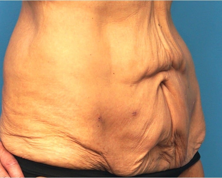Before Image: Tummy Tuck (Abdominoplasty) - right-front-oblique