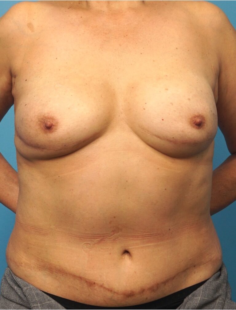 After Image: Breast Reconstruction – DIEP Flap - front