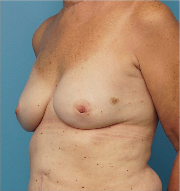 After Image: Breast Reconstruction – Implants - left-front-oblique