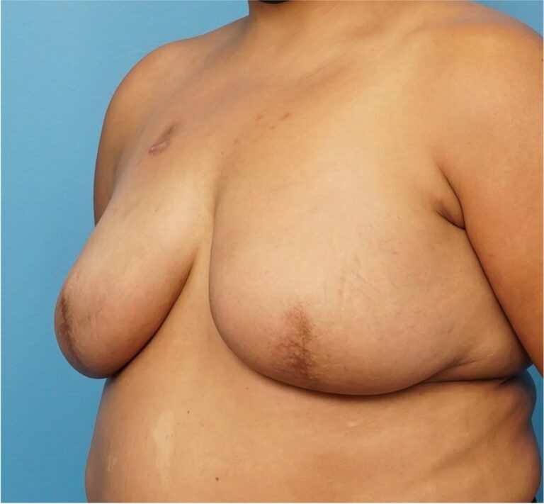 After Image: Breast Reconstruction – Implants - left-front-oblique