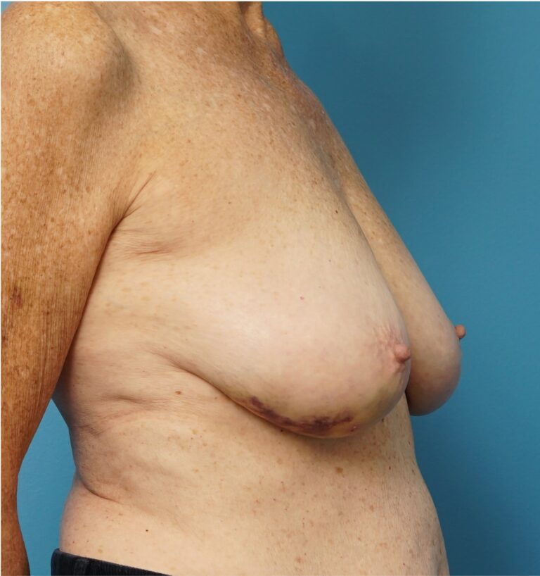 Before Image: Breast Reconstruction – Implants - right-front-oblique