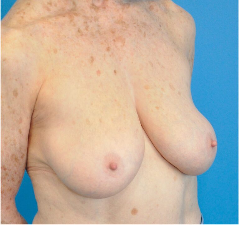 Before Image: Breast Reconstruction – Implants - right-front-oblique