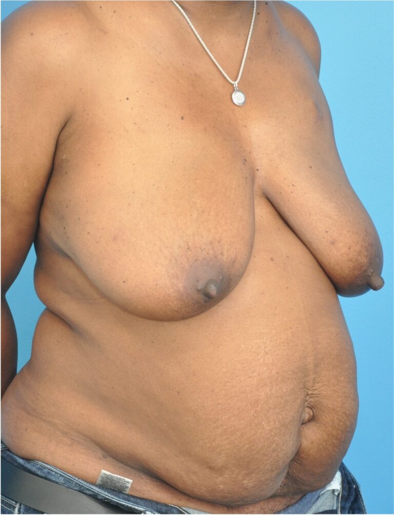 Before Image: Breast Reconstruction – DIEP Flap - right-front-oblique