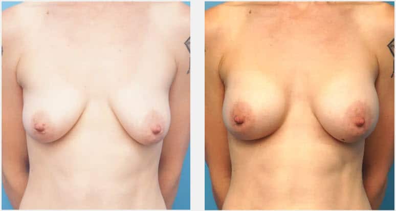 breast augmentation