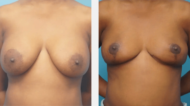 breast lift and implant removal