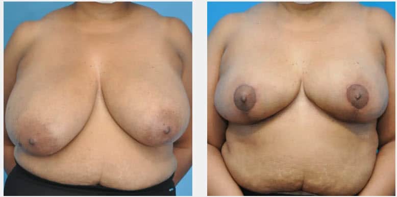 breast reduction