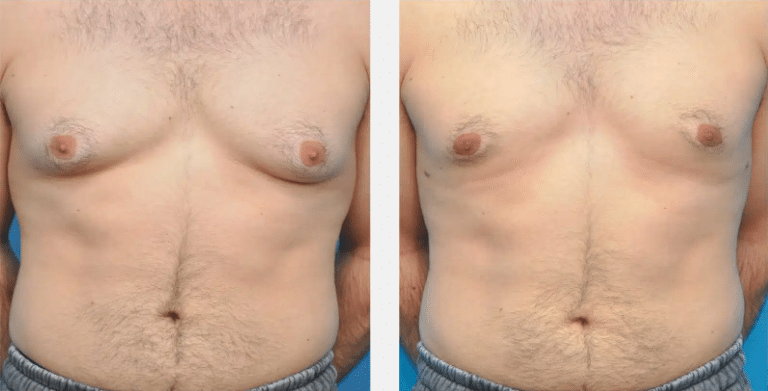 male breast reduction