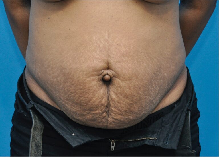 Before Image: Tummy Tuck (Abdominoplasty) with Liposuction - front