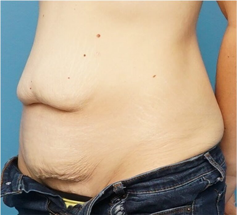 Before Image: Tummy Tuck (Abdominoplasty) - left-front-oblique