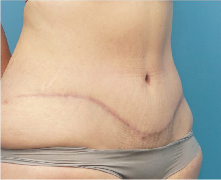 After Image: Tummy Tuck (Abdominoplasty) with Liposuction - right-front-oblique