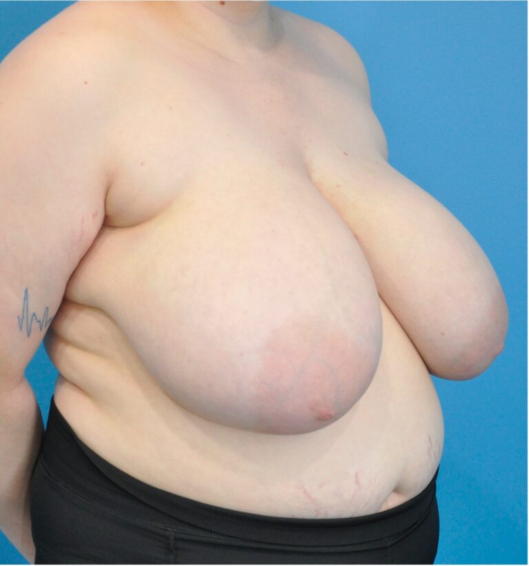 Before Image: Breast Reduction - right-front-oblique