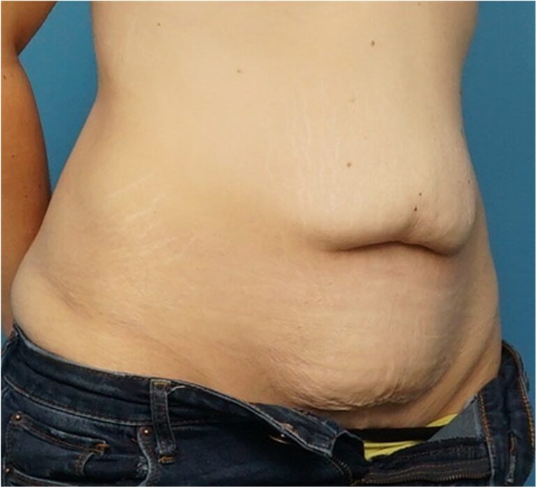 Before Image: Tummy Tuck (Abdominoplasty) - right-front-oblique