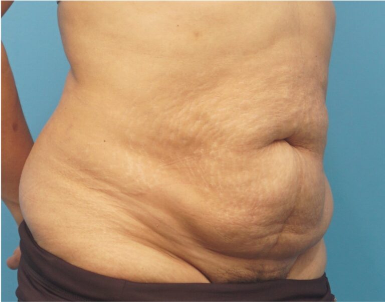Before Image: Tummy Tuck (Abdominoplasty) with Liposuction - right-front-oblique