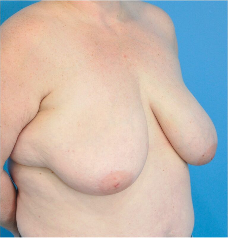 Before Image: Breast Reconstruction – Oncoplastic Breast Reduction - right-front-oblique