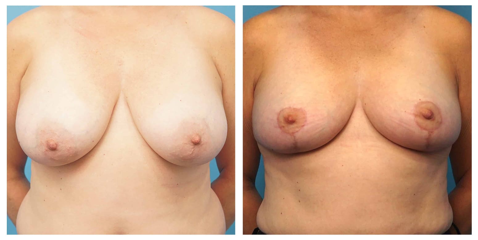 Breast Lift in Chicago and the North Shore Featured Case 71