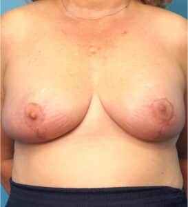 Breast Lift