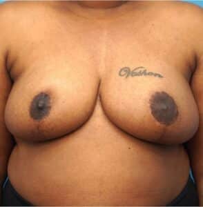 After Image: Breast Reduction