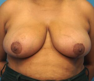 Breast Reconstruction – Oncoplastic Breast Reduction