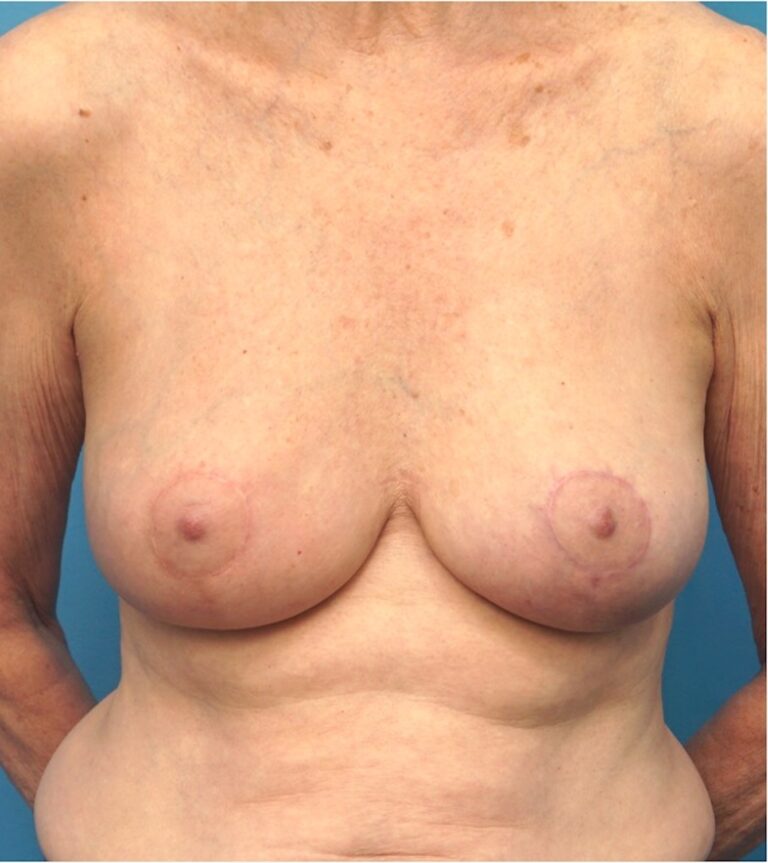 After Image: Breast Reconstruction – Oncoplastic Breast Reduction - front