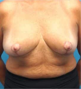 After Image: Breast Lift and Implant Removal