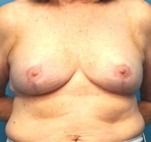 Breast Lift