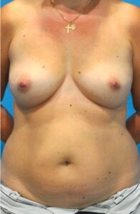 Before Image: Breast Reconstruction – DIEP Flap