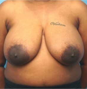 Breast Reduction