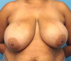 Breast Reconstruction – Oncoplastic Breast Reduction