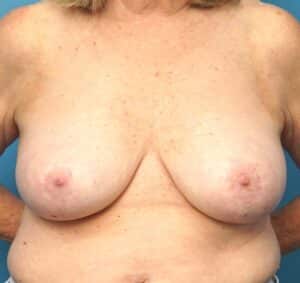 Breast Lift