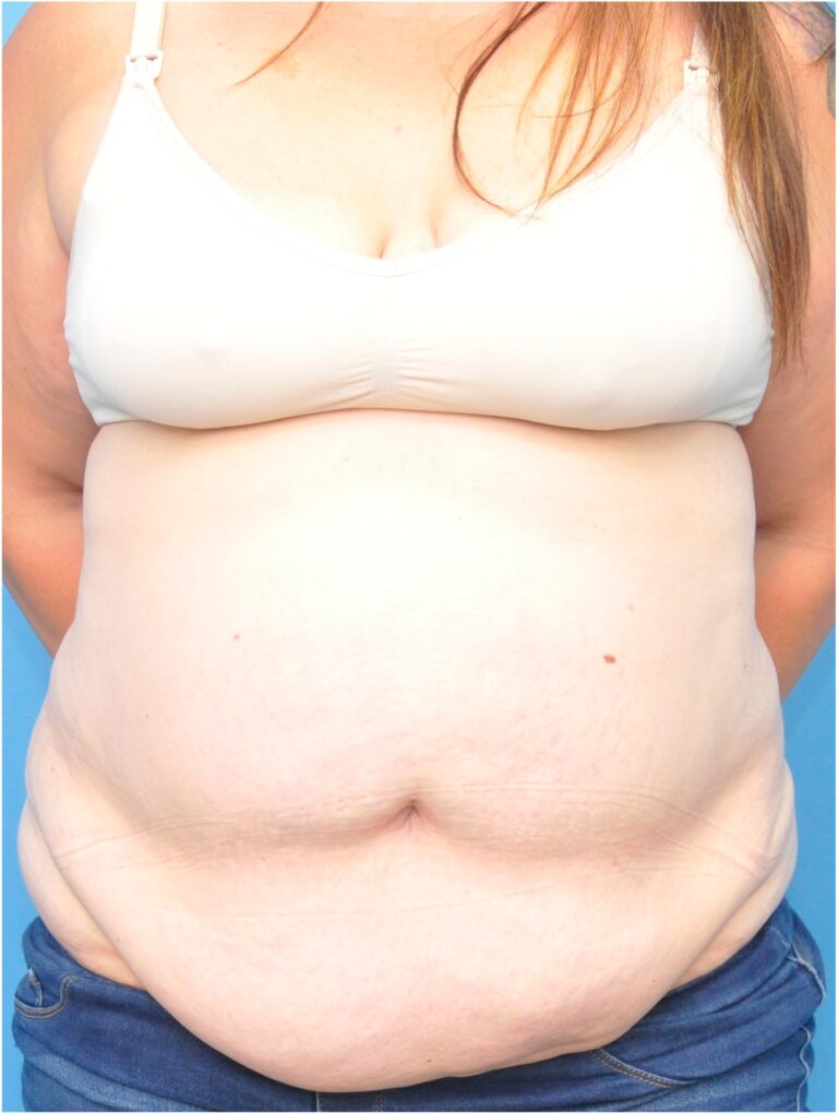 Before Image: Mommy Makeover (Breast Lift and Tummy Tuck) - front