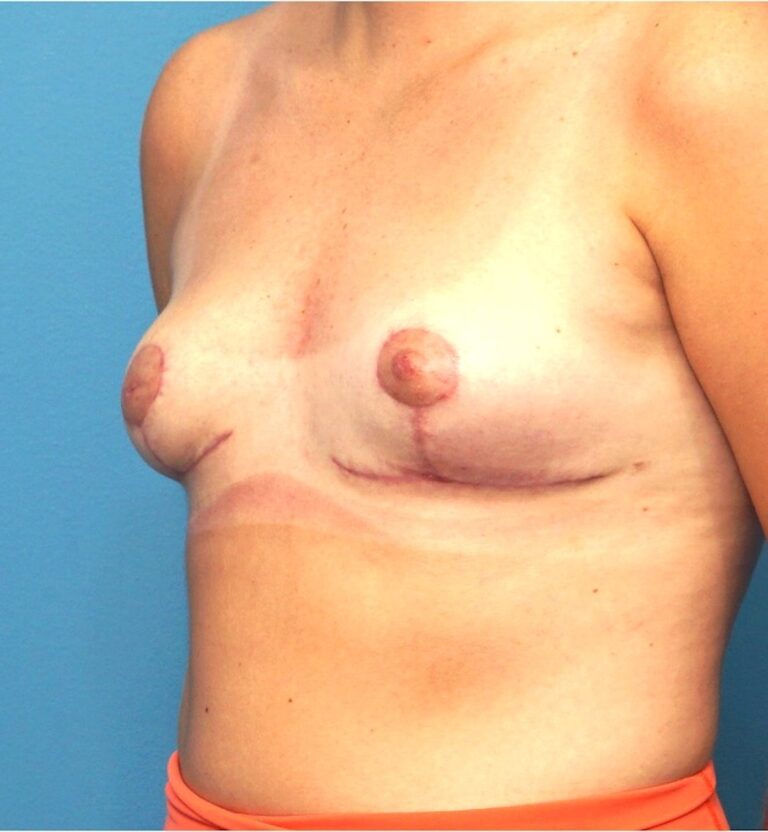 After Image: Breast Lift and Implant Removal - left-front-oblique