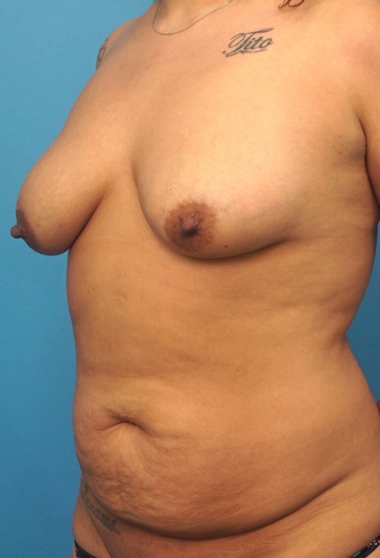 Before Image: Mommy Makeover (Breast Augmentation and Tummy Tuck) - left-front-oblique