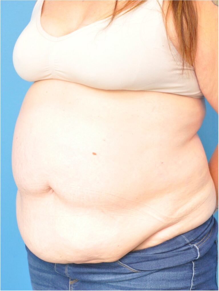 Before Image: Mommy Makeover (Breast Lift and Tummy Tuck) - left-front-oblique