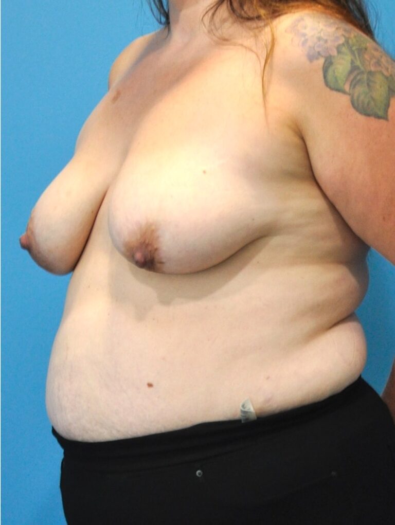 Before Image: Mommy Makeover (Breast Lift and Tummy Tuck) - left-front-oblique