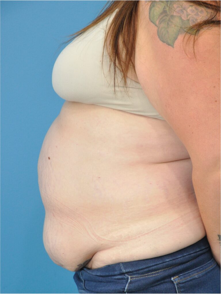 Before Image: Mommy Makeover (Breast Lift and Tummy Tuck) - left-side