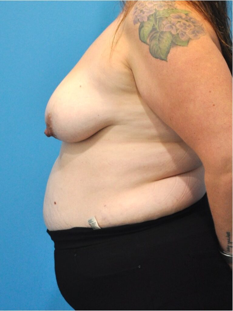 Before Image: Mommy Makeover (Breast Lift and Tummy Tuck) - left-side