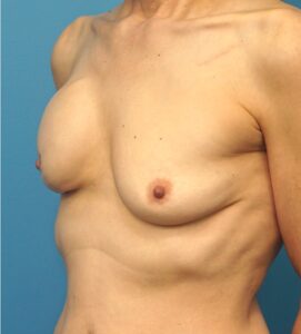 Breast Reconstruction Revision