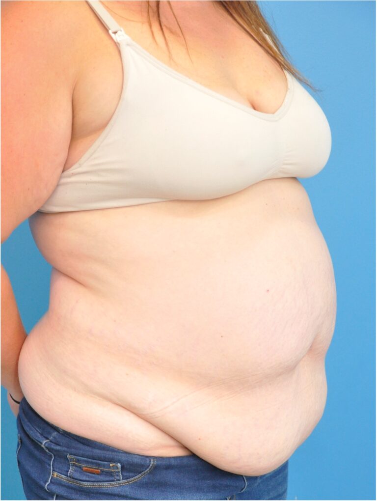 Before Image: Mommy Makeover (Breast Lift and Tummy Tuck) - right-front-oblique