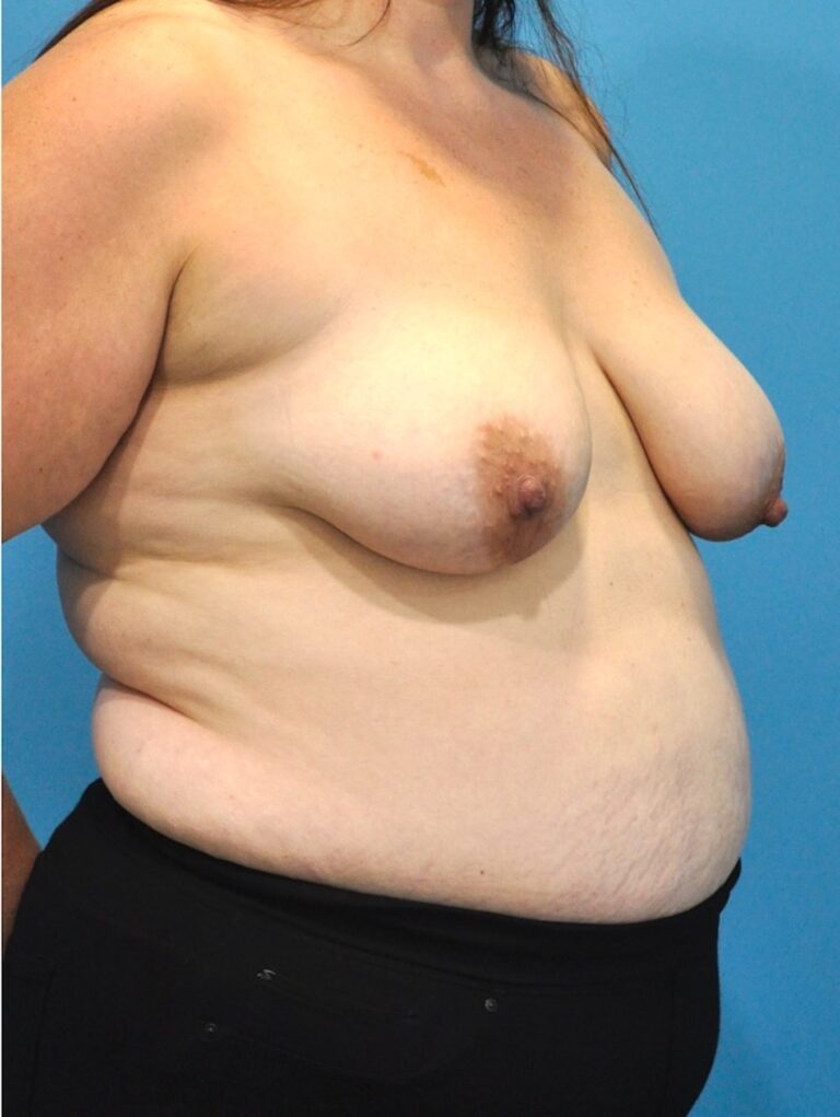 Before Image: Mommy Makeover (Breast Lift and Tummy Tuck) - right-front-oblique