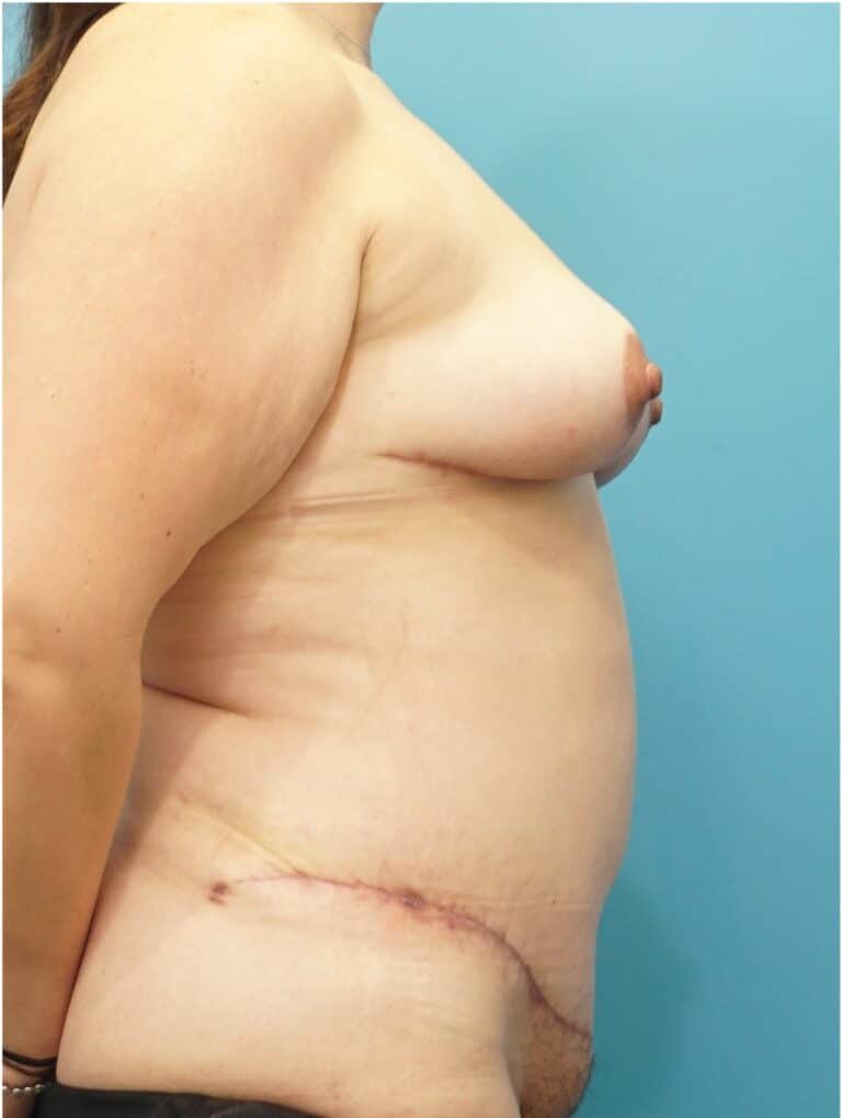 After Image: Mommy Makeover (Breast Lift and Tummy Tuck) - right-side