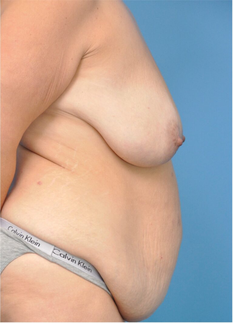 Before Image: Mommy Makeover (Breast Lift and Tummy Tuck) - right-side