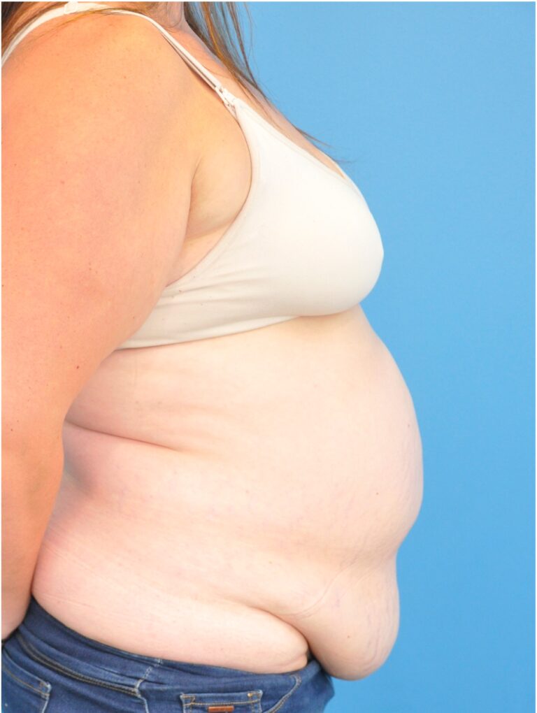 Before Image: Mommy Makeover (Breast Lift and Tummy Tuck) - right-side