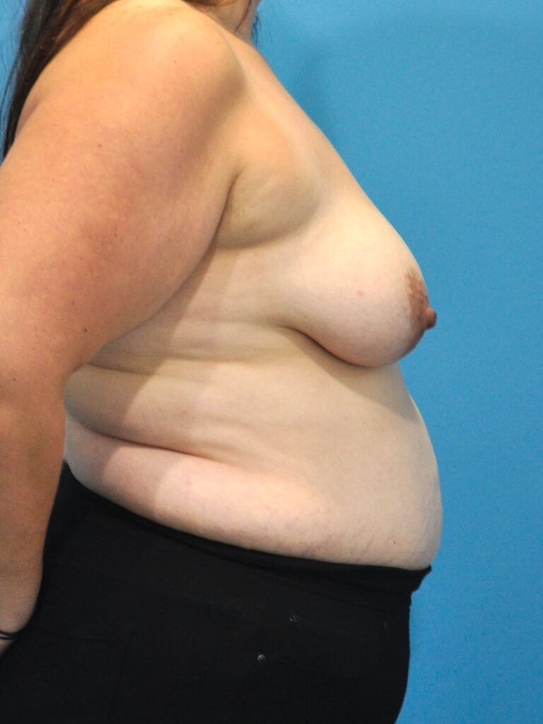 Before Image: Mommy Makeover (Breast Lift and Tummy Tuck) - right-side