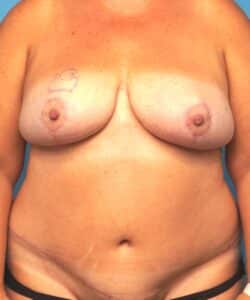 Mommy Makeover (Breast Reduction and Tummy Tuck)