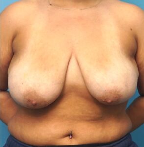 Breast Lift
